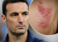 El estrés y las defensas bajas elevan el riesgo de herpes zóster, la infección que afectó a Lionel Scaloni