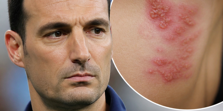 El estrés y las defensas bajas elevan el riesgo de herpes zóster, la infección que afectó a Lionel Scaloni