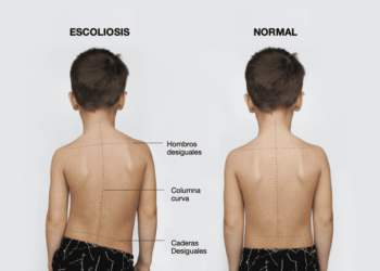 Mitos y recomendaciones: señales de alerta sobre la escoliosis en niños y adolescentes