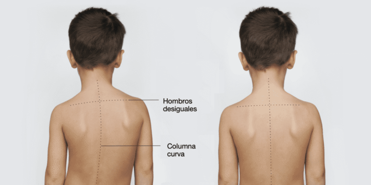 Mitos y recomendaciones: señales de alerta sobre la escoliosis en niños y adolescentes